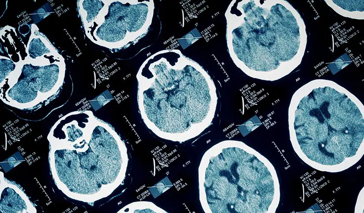Atlanta brain injury lawyers