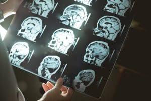 Increased Risk of Parkinson’s Disease After Mild Traumatic Brain Injury, According to New Study