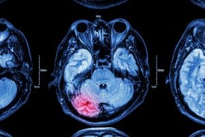 New Pediatric TBI Treatment Guidelines Issued by the CDC