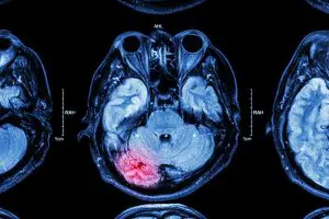 New Pediatric TBI Treatment Guidelines Issued by the CDC