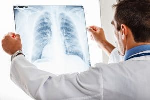 When Pneumonia Is Misdiagnosed
