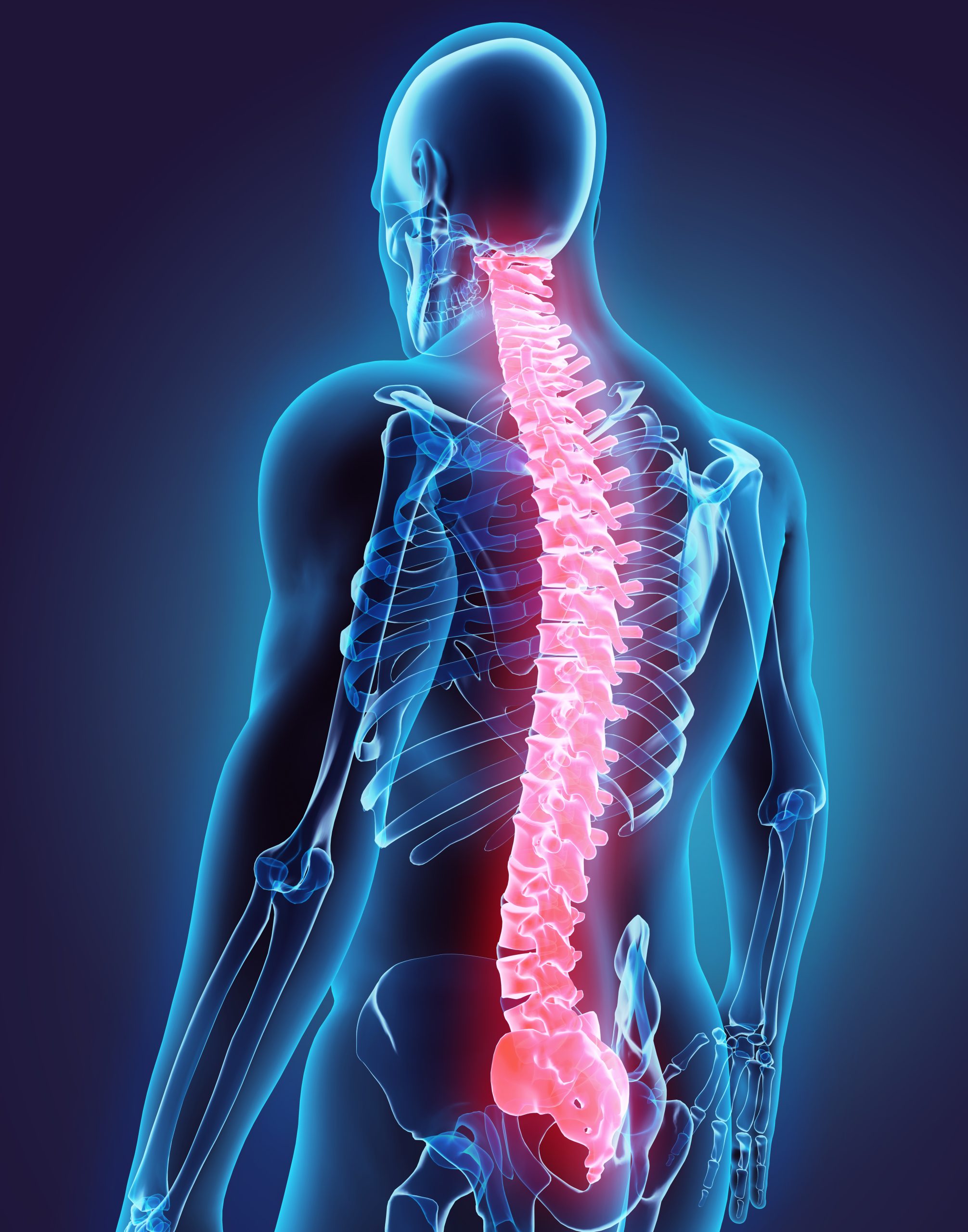 How Can Spinal Cord Stimulators Help Accident Victims? - Harris Lowry  Manton LLP