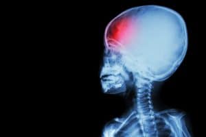What Are the Causes of Infant Brain Injuries?