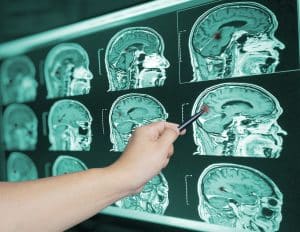 How Traumatic Injuries Affect Different Parts of the Brain
