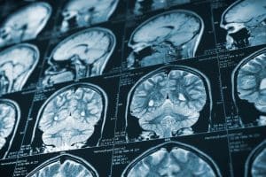 What Is an Anoxic Brain Injury?