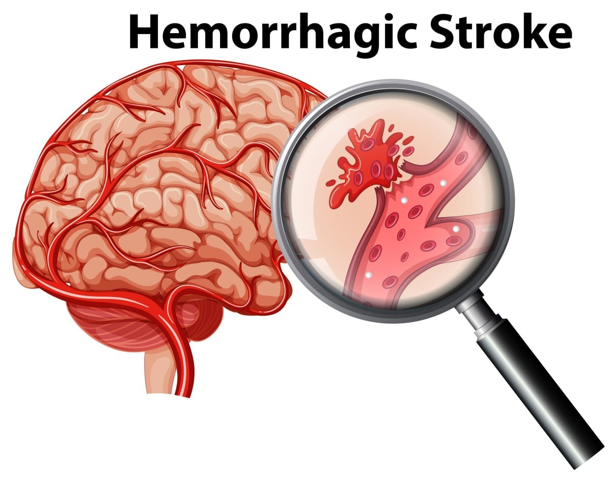 hemorrhagic stroke case study
