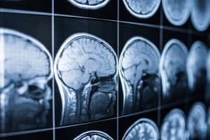Can a Traumatic Brain Injury Cause Seizures?