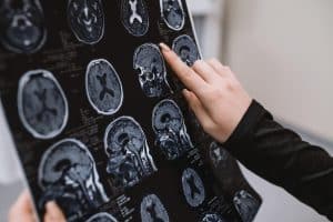 Traumatic Brain Injuries Are Financially Devastating (1)