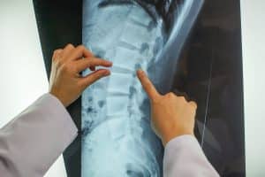 How Our Atlanta Attorneys Won a $47 Million Verdict for a Client with a Spinal Injury