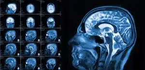 Neuropsychological Evaluations in Georgia Brain Injury Cases
